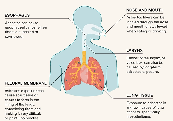 Asbestos Health Effects